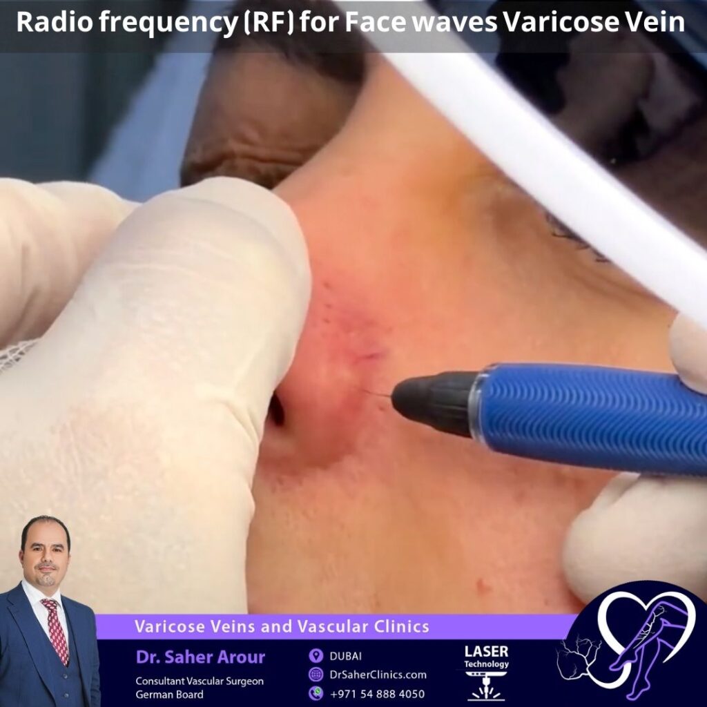 Radio frequency (RF) for Face waves Varicose Vein 