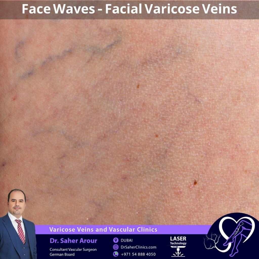 Face Waves - Facial Varicose Veins
