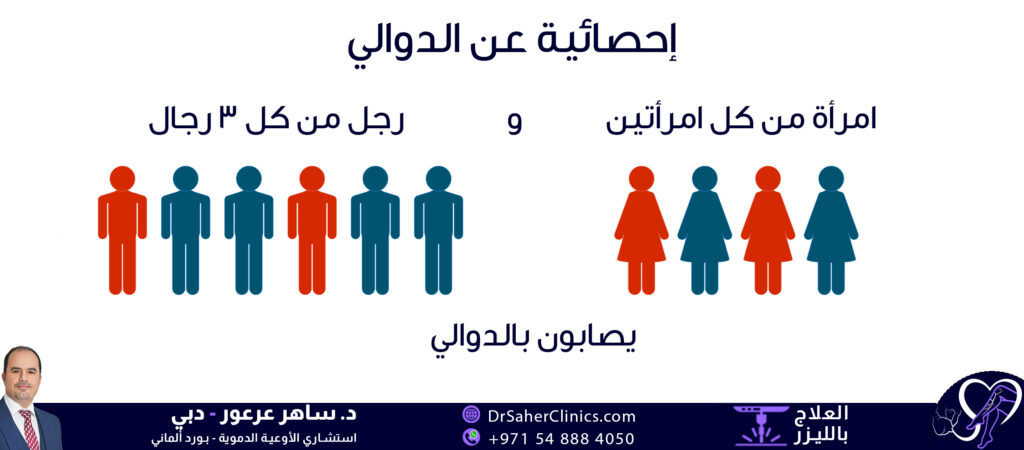 إحصائية عن الاصابة بدوالي الساقين بين الرجال. نسبة إصابة النساء بالدوالي أعلى من الرجال