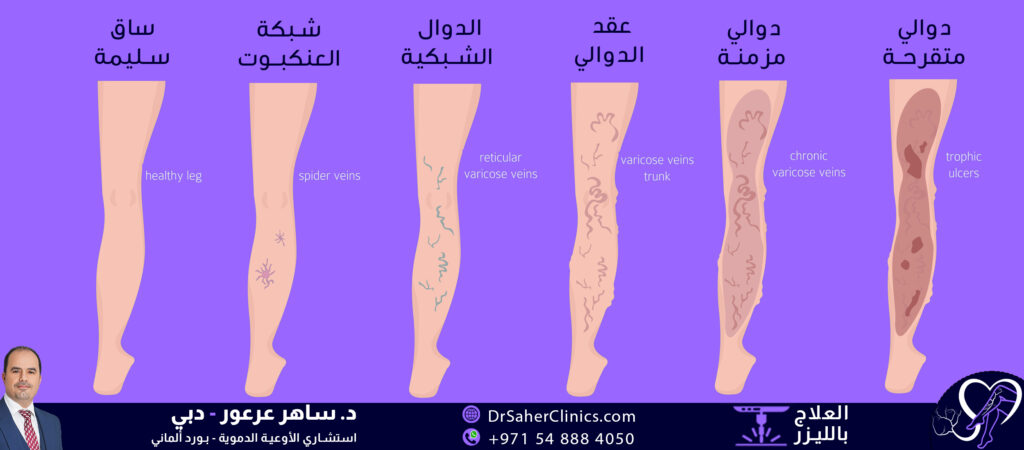 الصورة ١: المرحلة ١: دوالي خيوط الدوالي (العنكبوت)الصورة ٢: المرحلة ٢: شبكة دوالي الصورة ٣: المرحلة ٣: عقد دوالي الصورة ٤: المرحلة ٤: دوالي مزمنة مع قصور الصورة ٥: المرحلة ٥: قرح دوالي - أكزيما الدوالي صورة : مراحل الدوالي