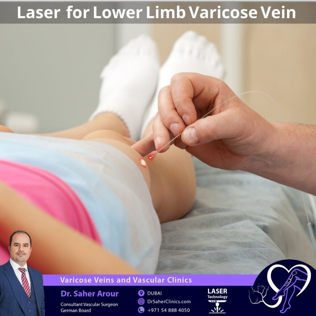 Laser Varicose Vein Treatment for the Leg