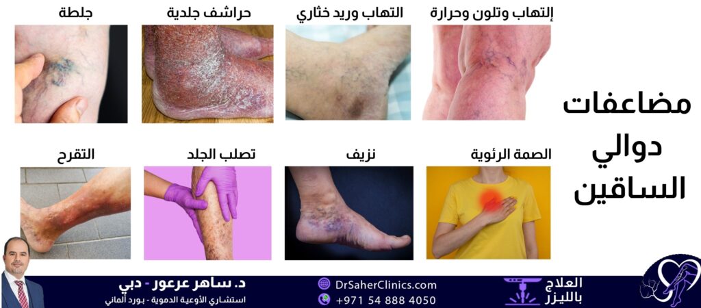 مضاعفات دوالي الساقين، هل الدوالي يمكن أن تصبح خطيرة على حياة الإنسان؟