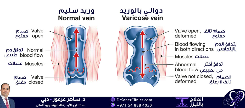 العلاقة بين العضلات السليمة في الساق و الإصابة بدوالي الساقين