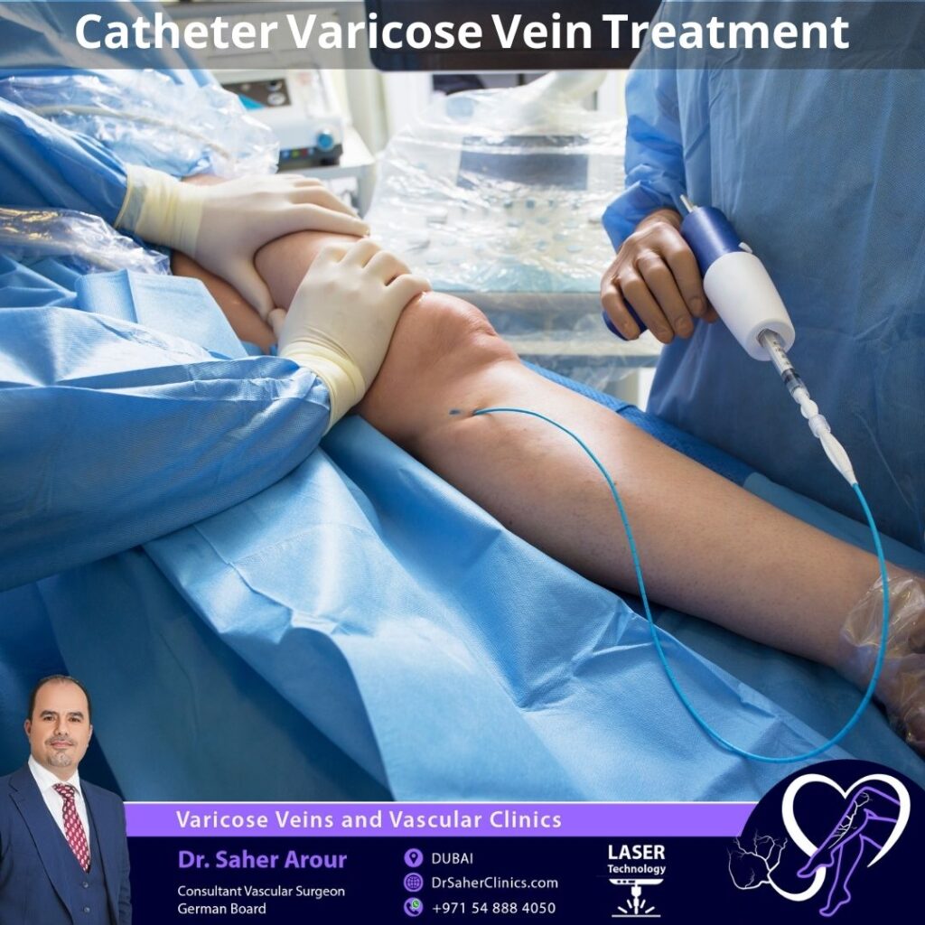 Catheter Varicose Veins Treatment for leg