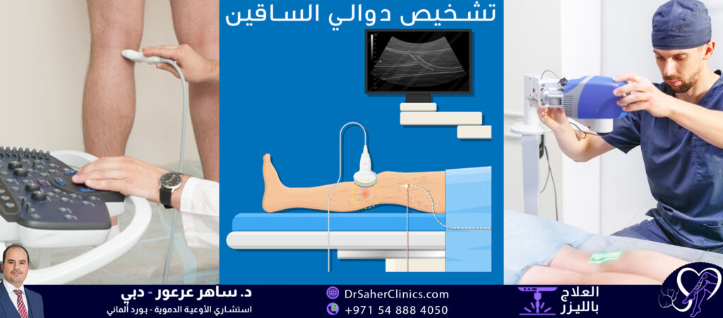 تشخيص دوالي الساقين