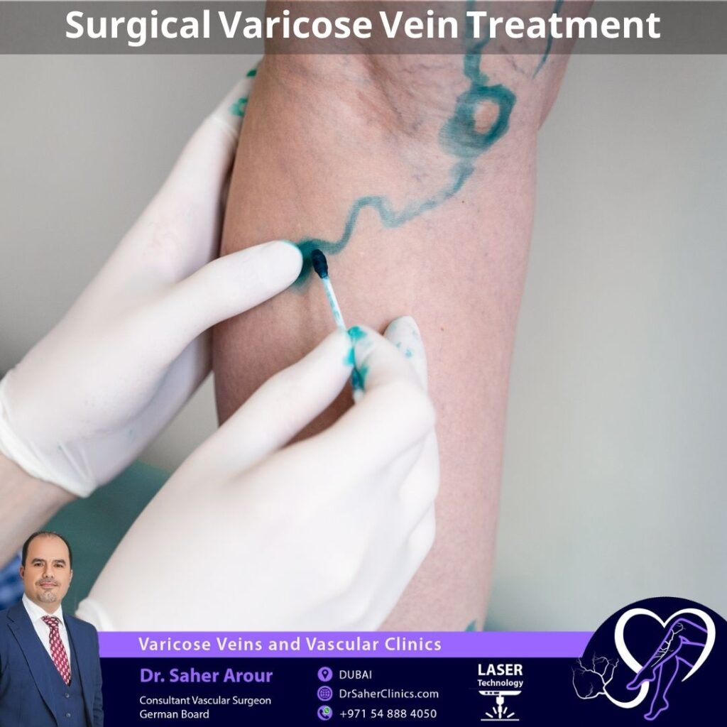 Surgical Varicose Vein Treatment for leg