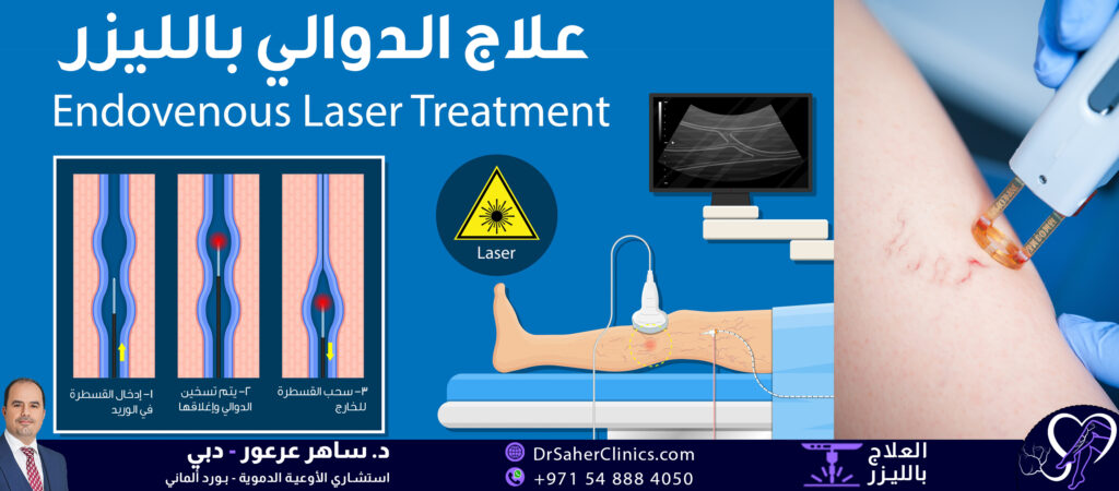 علاج الدوالي بالليزر