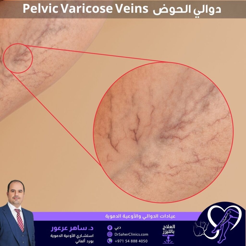 دوالي الحوض