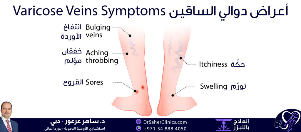 أعراض دوالي الساقين