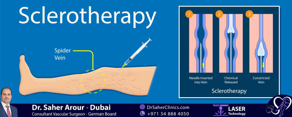 How Sclerotherapy Varicose Vein Treatment work?