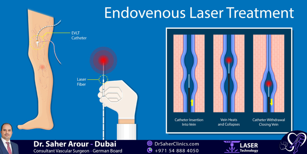 How does Laser Varicose Vein Treatment for the Leg work?
