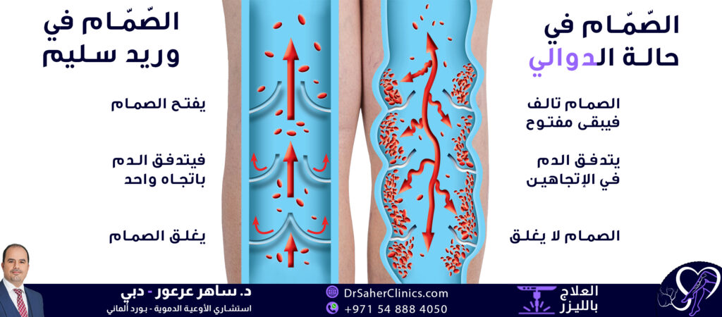 صمامات متعطلة ، بعض الدم يتحرك بإتجاه عكسي فتتكون الدوالي صمام سليم، وريد سليم، الدم يتحرك بإتجاه واحد لا دواليصمامات سليمة تجبر الدم على الحركة بإتجاه واحد صمامات متعطلة ، بعض الدم يتحرك بإتجاه عكسي فتتكون الدوالي