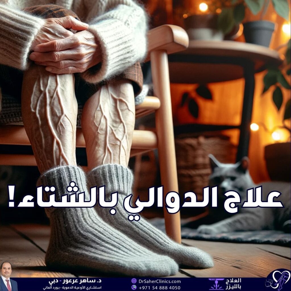 علاج الدوالي في الشتاء، هل له مميزات عن الصيف؟