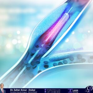 Procedure of angioplasty using a stent with balloon placement. advanced vascular surgery solutions