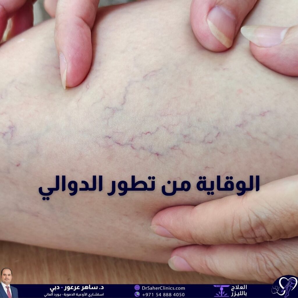 ما هي الدوالي وما هي أسبابها وما هي أبرز الأعراض المبكرة وما هي أكثر طرق الوقاية من تطور الدوالي فائدة ومن هو أبرز الأطباء المختصين