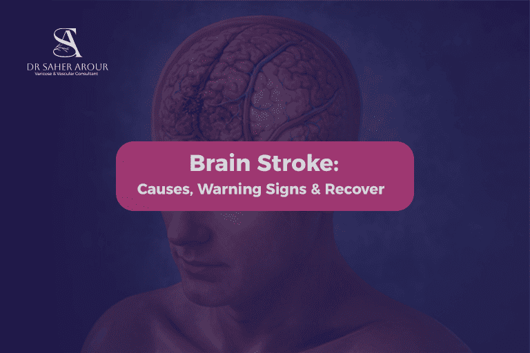 Brain Stroke