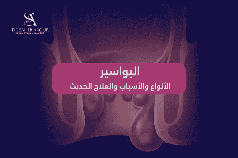 البواسير الأنواع والأسباب والعلاج الحديث