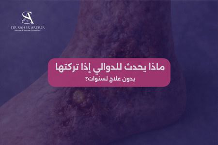 ماذا يحدث للدوالي إذا تركتها بدون علاج لسنوات؟