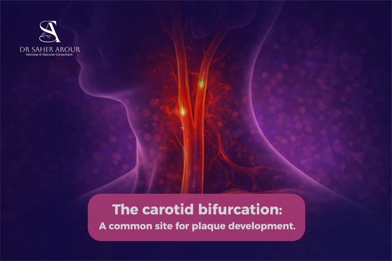 the carotid bifurcation