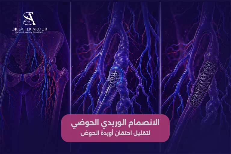 الانصمام الوريدي الحوضي