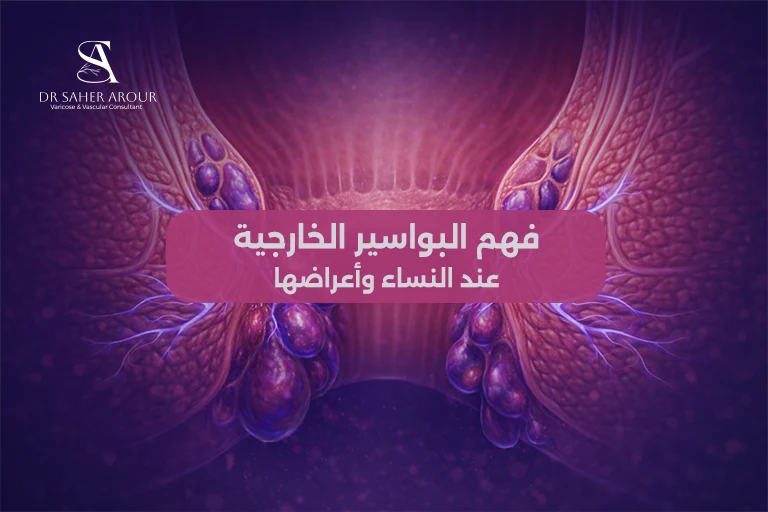 البواسير الخارجية عند النساء الأسباب والأعراض والعلاج