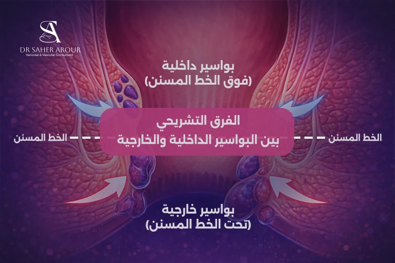 ما الفرق بين البواسير الداخلية والخارجية