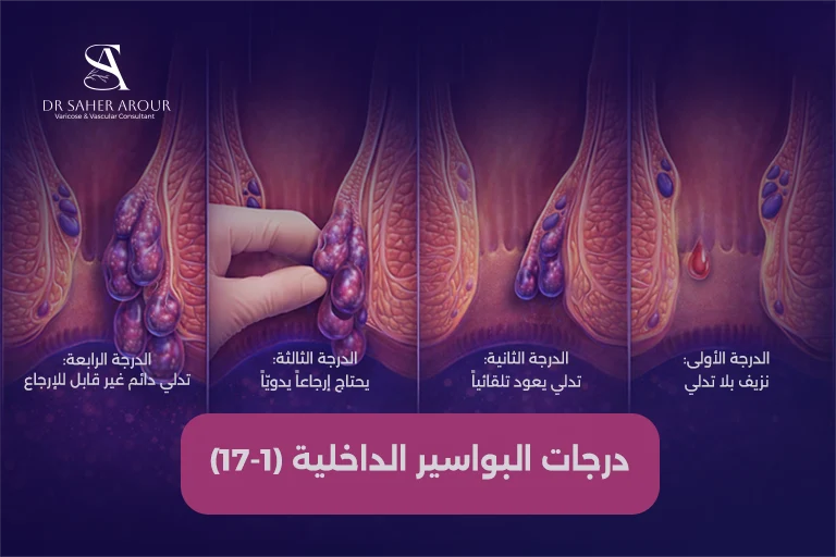 مراحل البواسير الداخلية