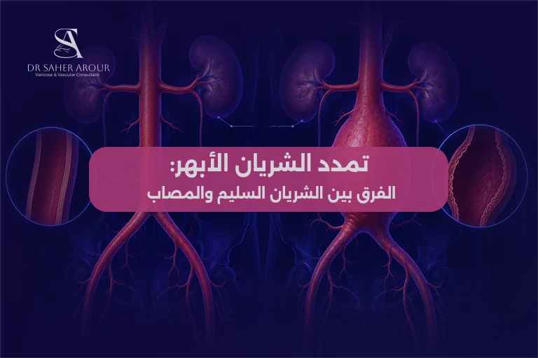 تمدد الشريان الأبهر الأسباب والمخاطر والعلاج بالقسطرة