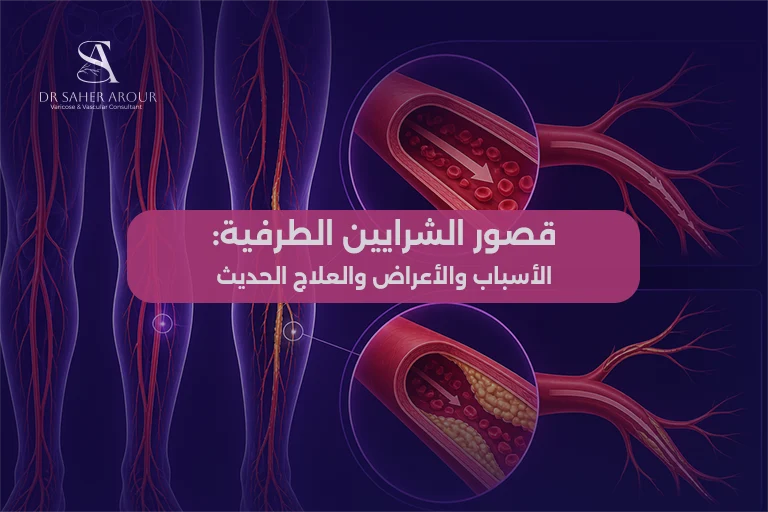 قصور الشرايين الطرفية - الأسباب والأعراض والعلاج الحديث