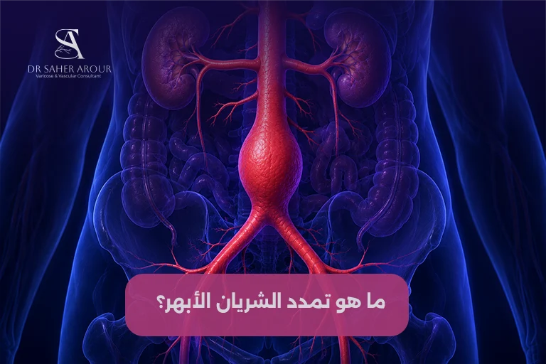ما هو تمدد الشريان الأبهر؟