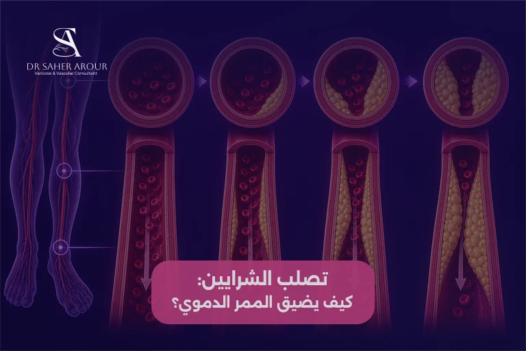 ما هو قصور الشرايين الطرفية؟