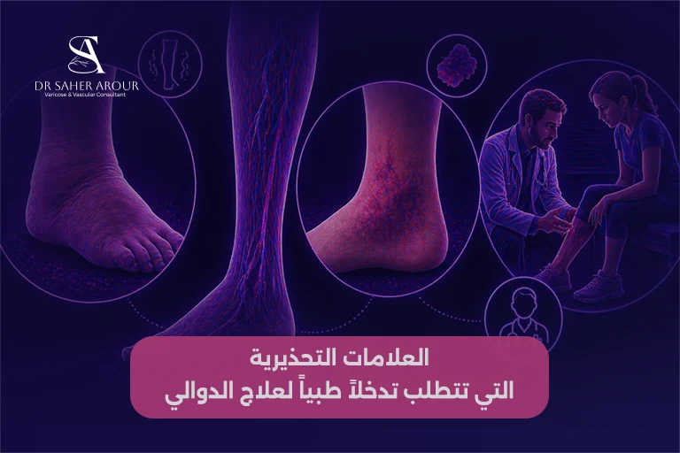 متى يصبح علاج الدوالي في المنزل غير كافٍ