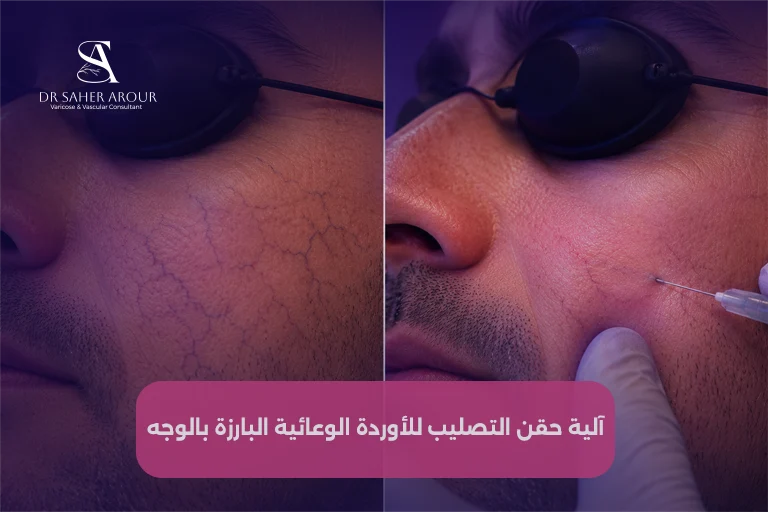 التصليب (Sclerotherapy) للأوردة الأكبر