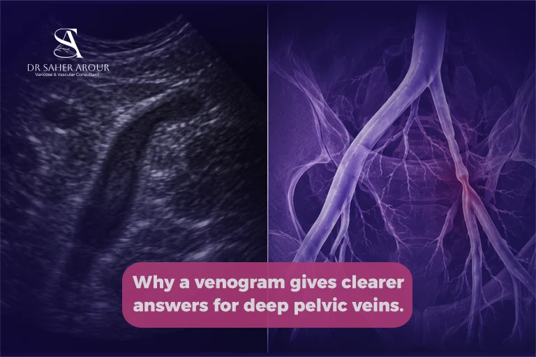 When Does a Vascular Surgeon Order a Venogram Instead of an Ultrasound