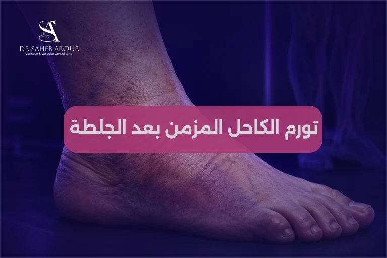 متلازمة ما بعد الجلطة العميقة