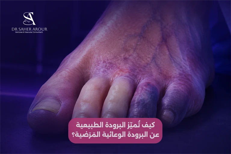 كيف تُميّز البرودة الطبيعية عن البرودة الوعائية المَرَضية؟