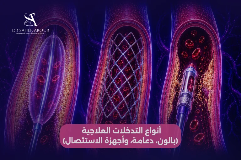 أنواع التدخلات العلاجية (بالون، دعامة، وأجهزة الاستئصال)